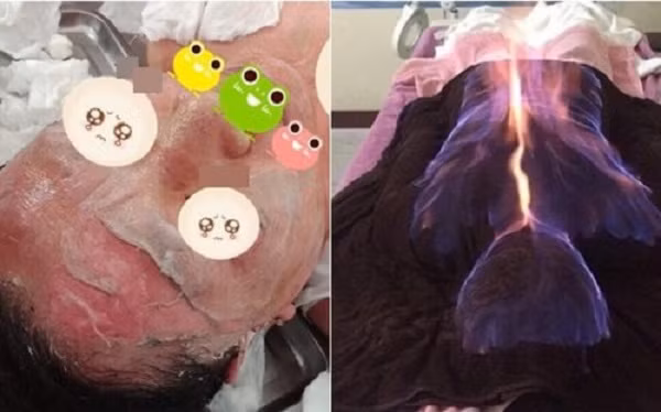 Nguy hiem rinh rap tu hoa lieu phap, dung lua lam dep va chua benh