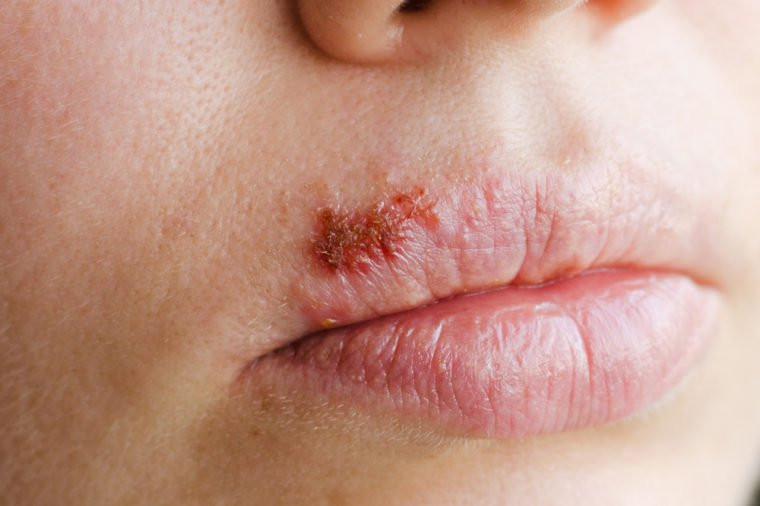 Herpes và nhiễm trùng khác: Các nhà khoa học đang nghiên cứu mối liên hệ giữa một số loại nhiễm trùng mãn tính, như herpes và bệnh Alzheimer. Các nhà nghiên cứu tin rằng các bệnh nhiễm trùng có thể đẩy nhanh sự tổn hại của bệnh Alzheimer bằng cách kích thích tình trạng viêm mãn tính.