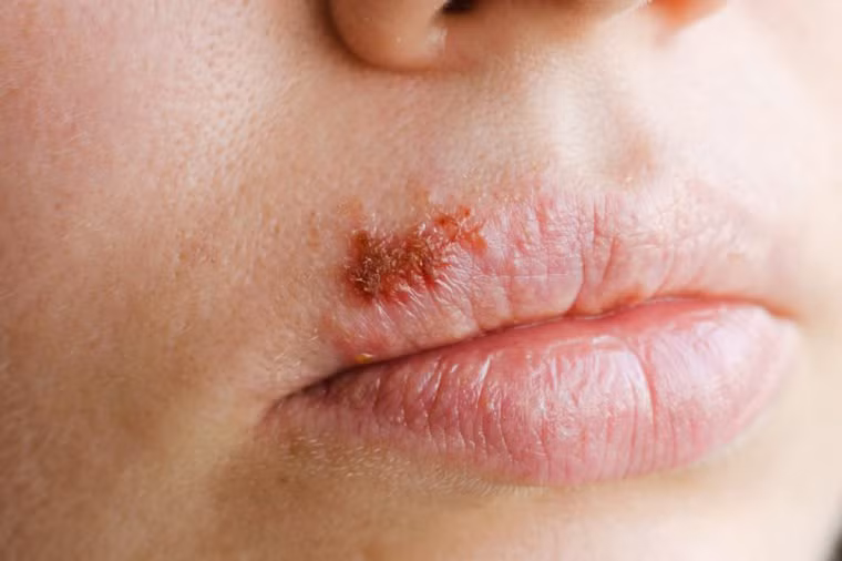 Herpes và nhiễm trùng khác: Các nhà khoa học đang nghiên cứu mối liên hệ giữa một số loại nhiễm trùng mãn tính, như herpes và bệnh Alzheimer. Các nhà nghiên cứu tin rằng các bệnh nhiễm trùng có thể đẩy nhanh sự tổn hại của bệnh Alzheimer bằng cách kích thích tình trạng viêm mãn tính.