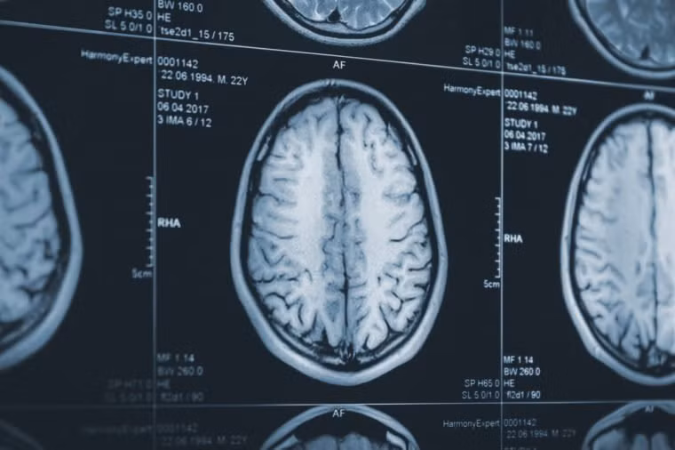 Hội chứng Down: Nếu những người bị hội chứng Down phát triển đủ tuổi, họ sẽ phát triển bệnh Alzheimer.