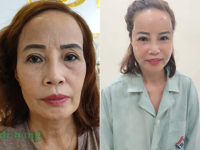 Sau khi tân trang khuôn mặt, dân mạng đã phải xuýt xoa vì chị Sao như ở tuổi 40.