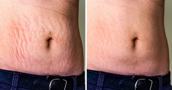 Làm mờ vết rạn da: Quả bơ chứa nhiều vitamin C, E giúp làm săn chắc và làm mờ vết rạn da hiệu quả. Trộn phần thịt của 1 quả bơ chín và 2 muỗng canh dầu hạnh nhân. Sau đó thoa kem lên đầu ngón tay và xoa bóp vùng da bị rạn. Để yên trong 35 phút, sau đó rửa sạch với nước ấm. Thực hiện 2 - 3 lần một tuần.