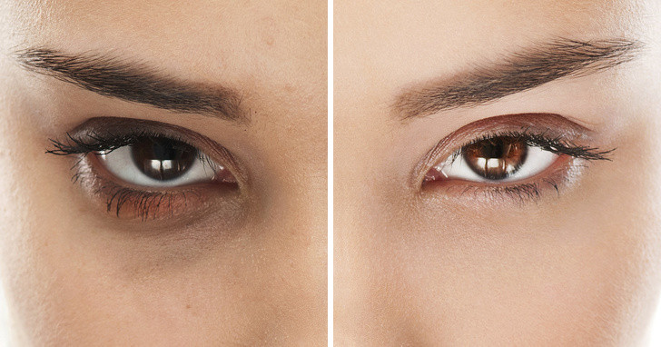 Trị quầng thâm mắt: Quầng thâm và bọng mắt xuất hiện do lưu thông máu kém. Vitamin A, C, D và B3 trong bơ giúp giảm vấn đề này. Xay nhuyễn 1/2 quả bơ và 4 quả dưa chuột trong máy xay. Để hỗn hợp trong tủ lạnh trong 1 giờ. Sau đó thoa hỗn hợp lên mắt trong 25 phút. Bôi mỗi sáng để đạt hiệu quả cao.