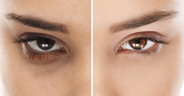 Trị quầng thâm mắt: Quầng thâm và bọng mắt xuất hiện do lưu thông máu kém. Vitamin A, C, D và B3 trong bơ giúp giảm vấn đề này. Xay nhuyễn 1/2 quả bơ và 4 quả dưa chuột trong máy xay. Để hỗn hợp trong tủ lạnh trong 1 giờ. Sau đó thoa hỗn hợp lên mắt trong 25 phút. Bôi mỗi sáng để đạt hiệu quả cao.