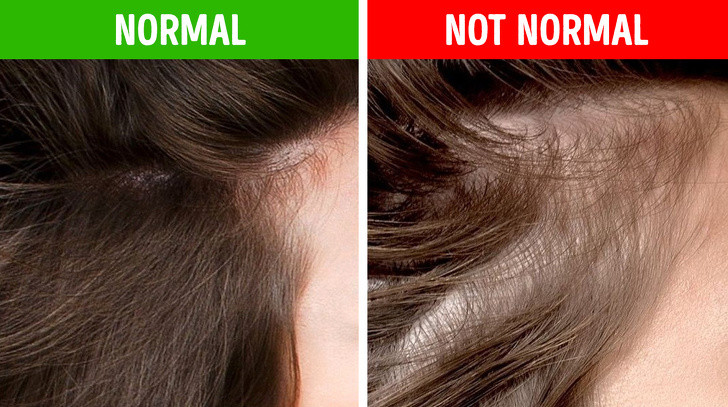 Tóc bạc ở hai bên mai: Những người bị nóng gan thường biểu hiện nóng tính, khó chịu, khô miệng, đắng miệng, khô lưỡi, mắt cay, dần dần sẽ khiến tỳ vị bị thương tổn. Họ còn bị bạc tóc ở hai bên mai.