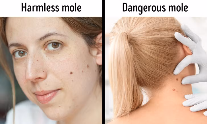 Tẩy nốt ruồi: Thói quen làm đẹp này có thể dẫn đến nhiều biến chứng nguy hiểm như nhiễm trùng, sẹo, ung thư.