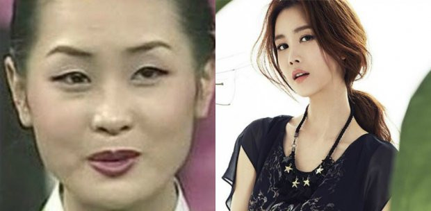 Bức ảnh trước - sau khi thẩm mỹ từng gây sốt của nữ diễn viên Hàn Quốc.