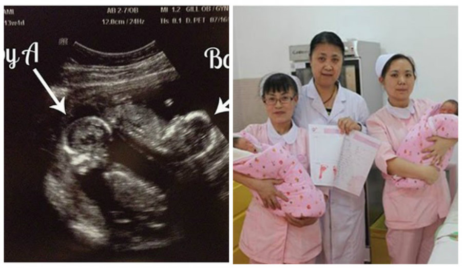 Ốm nghén trầm trọng Một trong những biểu hiện dễ thấy nhất của mẹ mang thai đôi là tình trạng ốm nghén sẽ trầm trọng hơn rất nhiều. Nguyên nhân được cho là do hormone gonadotropin ở mẹ mang song thai sẽ cao hơn. Vì vậy chị em sẽ thường xuyên có cảm giác buồn nôn, nôn ói đặc biệt trong 3 tháng đầu thai kỳ.