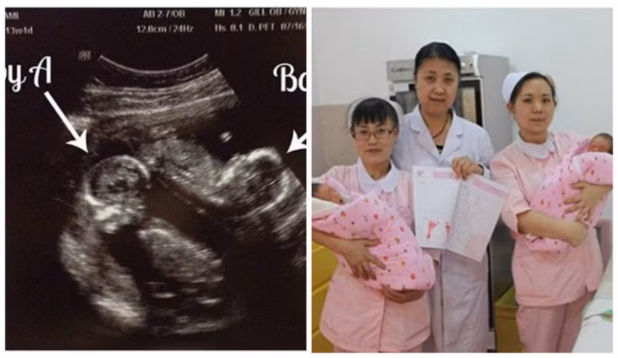 Ốm nghén trầm trọng Một trong những biểu hiện dễ thấy nhất của mẹ mang thai đôi là tình trạng ốm nghén sẽ trầm trọng hơn rất nhiều. Nguyên nhân được cho là do hormone gonadotropin ở mẹ mang song thai sẽ cao hơn. Vì vậy chị em sẽ thường xuyên có cảm giác buồn nôn, nôn ói đặc biệt trong 3 tháng đầu thai kỳ.