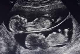 Không chỉ có thế, các bà mẹ mang thai đôi thường phàn nàn rằng họ còn đau lưng, khó ngủ và ợ nóng nhiều hơn các mẹ mang thai đơn. Tỷ lệ thiếu máu và xuất huyết khi sinh nở ở mẹ mang song thai cũng trầm trọng hơn nhiều.