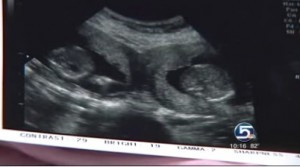 Tuy hai em bé sinh ra không phải là cặp song sinh nhưng trong mắt mọi người đây đích thị là cặp song sinh và bà mẹ này vẫn vô cùng hạnh phúc. Đúng là tự nhiên có nhiều điều thật kỳ lạ.