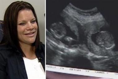 Theo đó, hai trứng khác nhau đã được thụ tinh không cùng một thời điểm mà cách nhau một khoảng thời gian. Thời gian này có thể kéo dài từ 24-48 giờ. Bác sĩ đã hỏi bà mẹ gần gũi chồng bao nhiêu lần, lúc này, cô mới nhận ra đúng là hai em bé mình sinh ra tuy chào đời cùng lúc nhưng lại không phải là cặp song sinh.