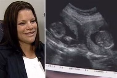 Theo đó, hai trứng khác nhau đã được thụ tinh không cùng một thời điểm mà cách nhau một khoảng thời gian. Thời gian này có thể kéo dài từ 24-48 giờ. Bác sĩ đã hỏi bà mẹ gần gũi chồng bao nhiêu lần, lúc này, cô mới nhận ra đúng là hai em bé mình sinh ra tuy chào đời cùng lúc nhưng lại không phải là cặp song sinh.