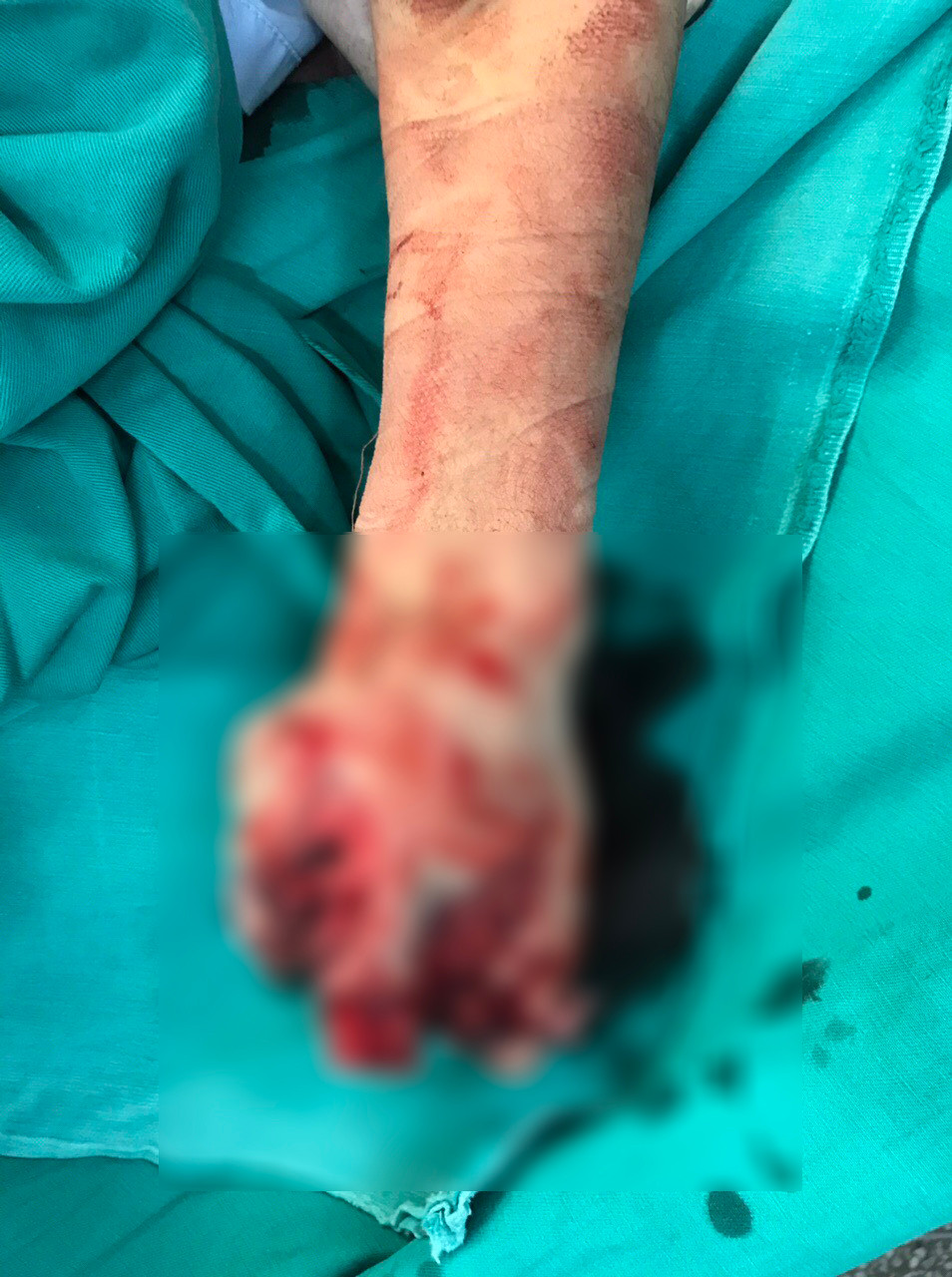 Dung iphone trong khi sac, benh nhi phai cat cut tay