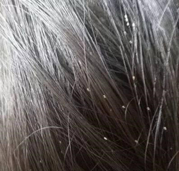 Chấy rất dễ lây lan và một khi chúng bò lên đầu bạn, bạn có thể bị nhiễm trùng. Chấy có thể di chuyển qua các phương tiện như bàn chải đánh răng, lược, kẹp tóc, dây buộc tóc, tai nghe hoặc mũ.