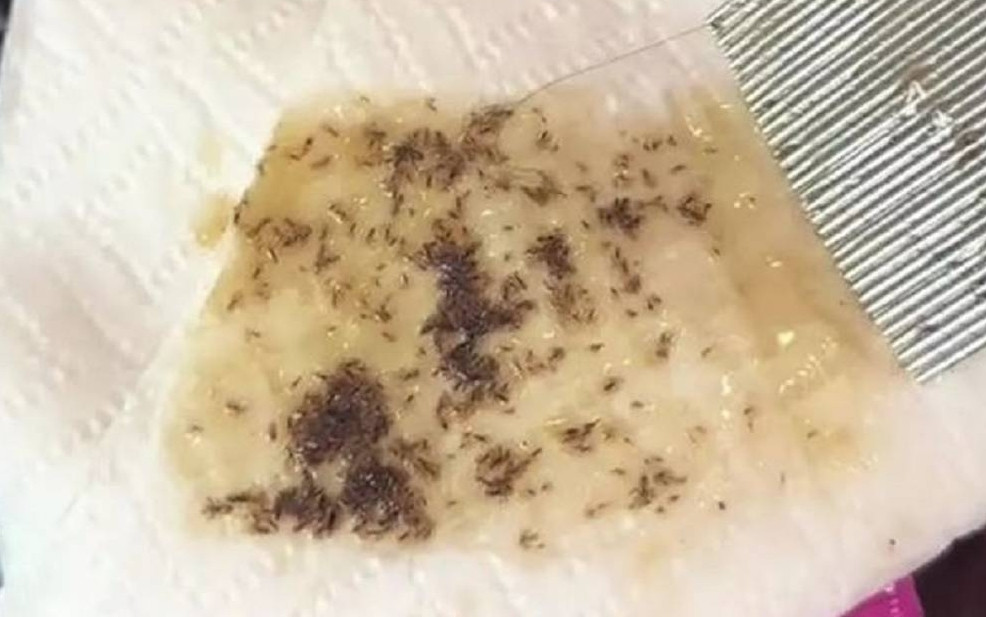 May mắn thay, sau 4 lần được bác sĩ tận tình xử lý, tóc và da đầu của cô khỏe mạnh trở lại.