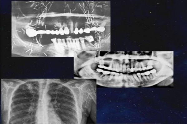Nu benh nhan dot quy, bac si phat hien chuyen ghe ron