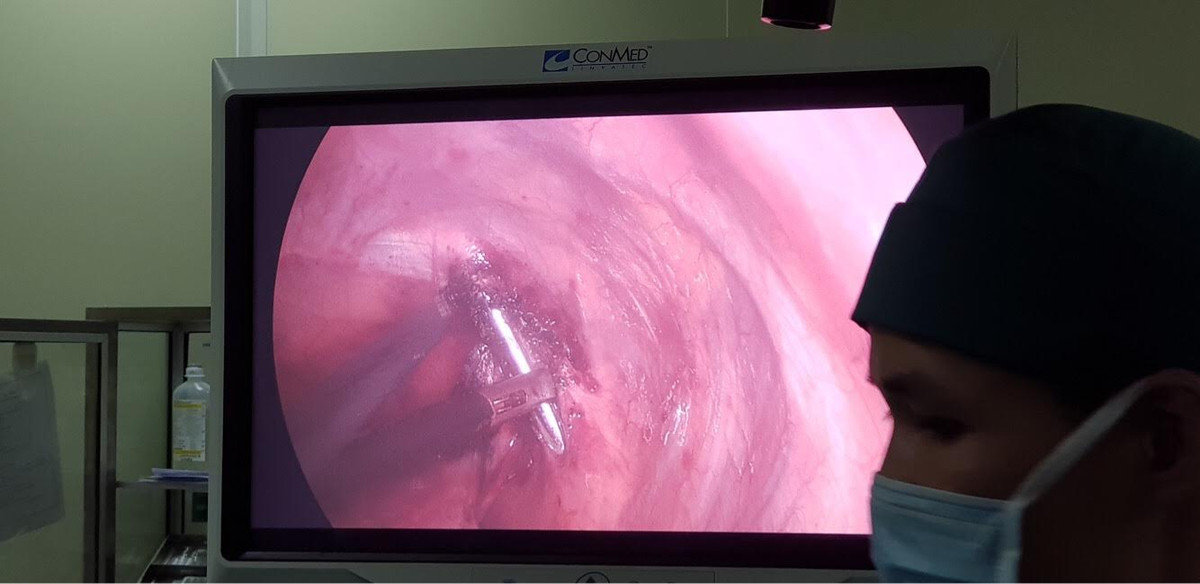 Phau thuat rut dinh dai 12cm xuyen qua dinh phoi