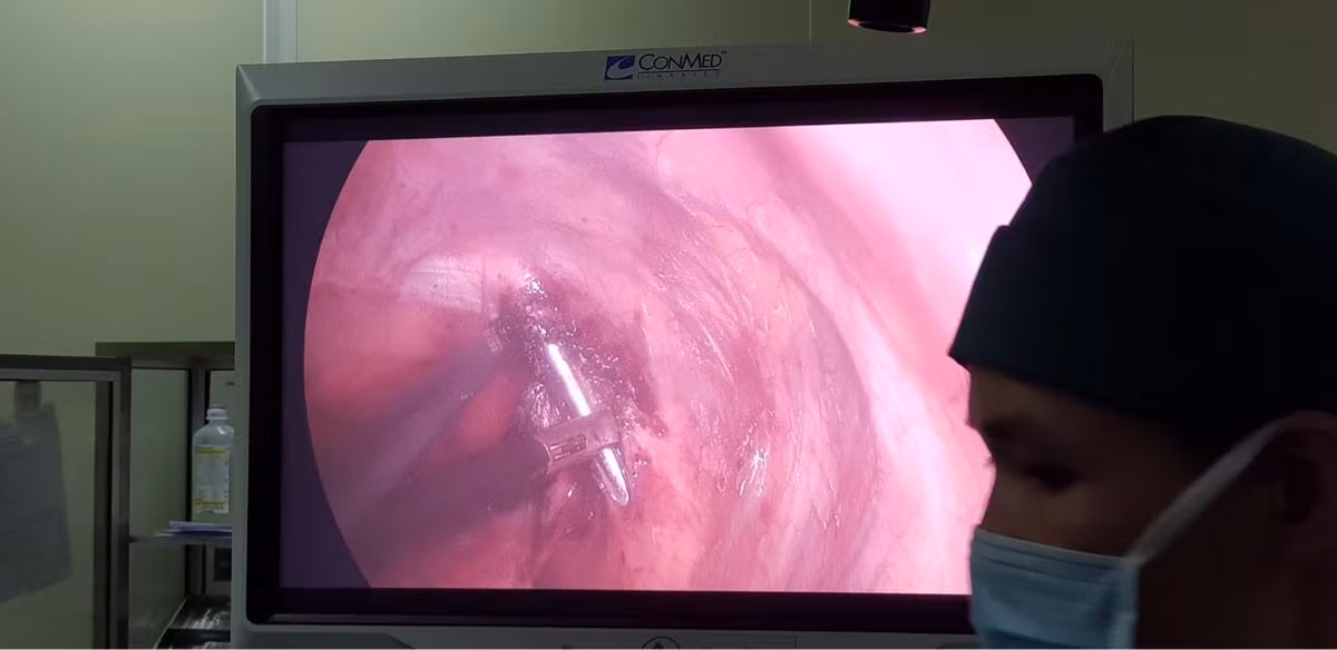 Phau thuat rut dinh dai 12cm xuyen qua dinh phoi