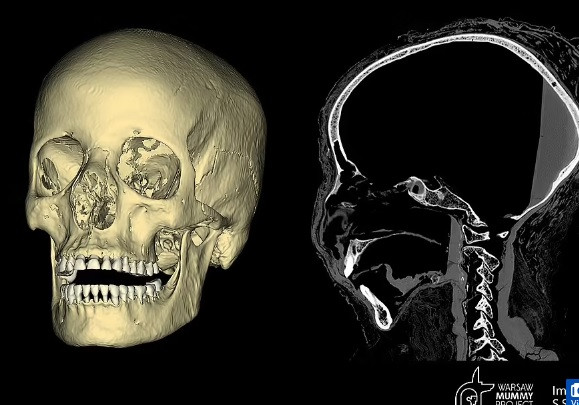 Mới đây, các chuyên gia pháp y sử dụng phương pháp quét CT và chụp X-quang hộp sọ của xác ướp nhằm phục dựng gương mặt của "Quý bà bí ẩn".