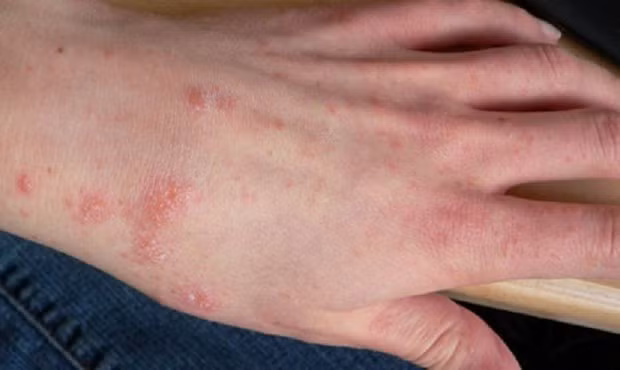 Quang Ngai: Hon nua lang mac benh ghe-Hinh-2