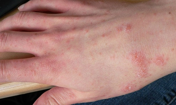  Chữa trị một số bệnh về da: Ngọn rau muống có thể dùng làm thuốc đắp để điều trị một số bệnh về da như hắc lào, nấm da chân… Đây cũng là loại rau có khả năng giúp ngăn ngừa ung thư da và trị mụn trứng cá, bệnh chàm và bệnh vẩy nến hiệu quả. Ảnh minh họa