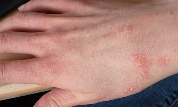  Chữa trị một số bệnh về da: Ngọn rau muống có thể dùng làm thuốc đắp để điều trị một số bệnh về da như hắc lào, nấm da chân… Đây cũng là loại rau có khả năng giúp ngăn ngừa ung thư da và trị mụn trứng cá, bệnh chàm và bệnh vẩy nến hiệu quả. Ảnh minh họa