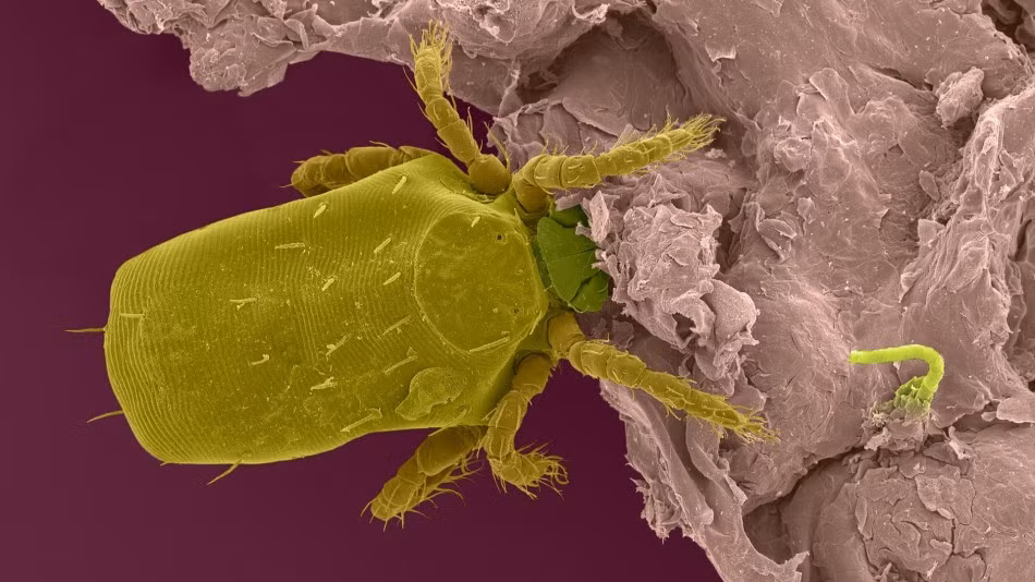 Trong ảnh là một con bọ ve chigger, khi ký sinh trên cơ thể người, chúng không cắn nhưng đào hang và tạo thành các lỗ nhỏ trên da, sau đó ăn dần vào phần thịt bên trong. (Nguồn Sina)