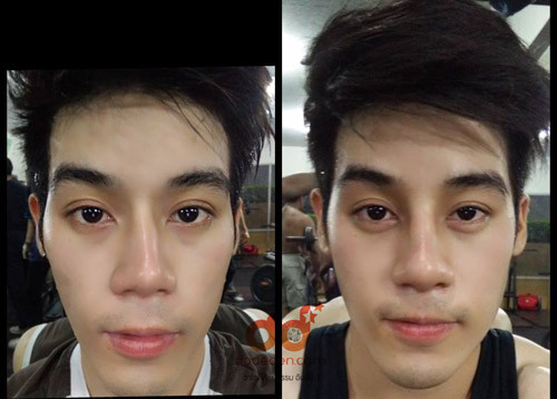 Chàng trai trẻ cho biết dù chiếc mũi của anh vốn đã khá cao nhưng nếu nhìn kỹ nó có vẻ hơi lệch sang bên trái. Chính điều này đã khiến Dechapat mất đi sự tự tin mỗi khi đứng trước ống kính.