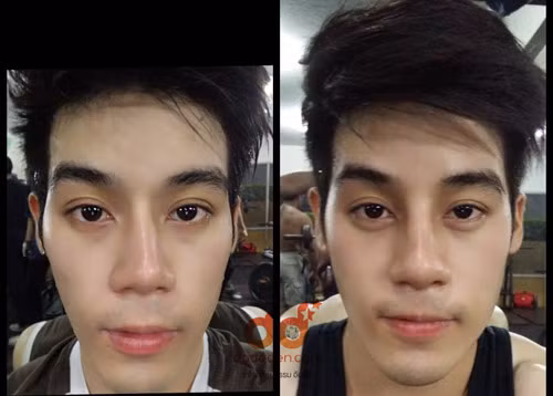 Chàng trai trẻ cho biết dù chiếc mũi của anh vốn đã khá cao nhưng nếu nhìn kỹ nó có vẻ hơi lệch sang bên trái. Chính điều này đã khiến Dechapat mất đi sự tự tin mỗi khi đứng trước ống kính.