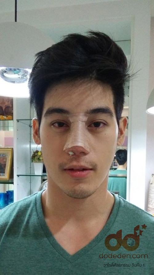 Vốn rất đẹp trai, nhưng Dechapat từng tiết lộ rằng anh chưa bao giờ cảm thấy thực sự tự tin với khuôn mặt của chính mình. Vì vậy mới đây anh quyết định làm phẫu thuật thẩm mỹ để tiếp tục cải thiện nhan sắc.