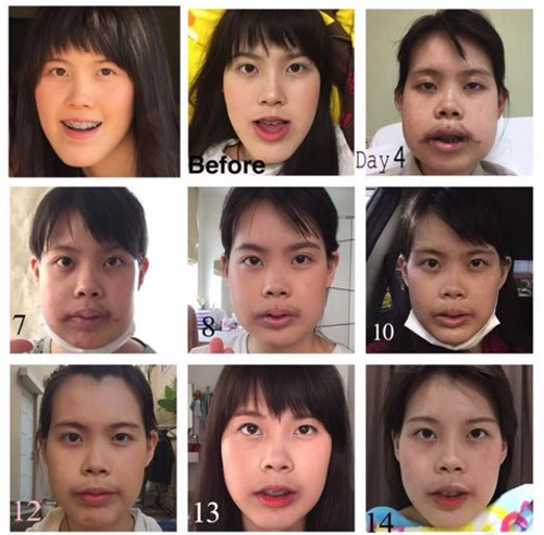 Tưởng chừng khuôn mặt của cô gái trẻ rất khó để "tái tạo", nhưng kỳ lại thay, chỉ sau quá trình làm phẫu thuật thẩm mỹ kéo dài 14 ngày, cô gái trẻ như lột xác, sở hữu khuôn mặt hoàn toàn mới.