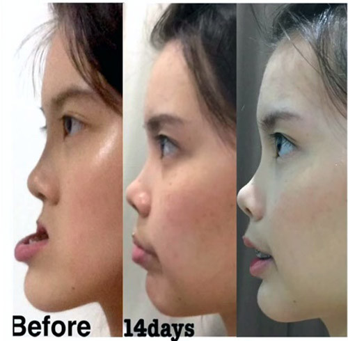 Điều gây kinh ngạc trên khuôn mặt của cô gái này là phần hàm dưới nhô ra phía trước đến gần 10cm. Điều này khiến khuôn mặt của cô nhìn rất khó coi.