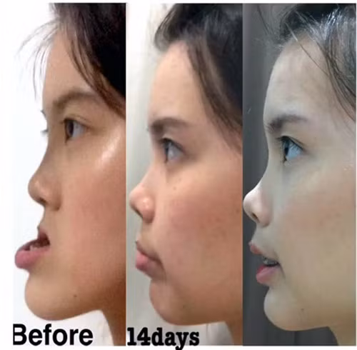 Điều gây kinh ngạc trên khuôn mặt của cô gái này là phần hàm dưới nhô ra phía trước đến gần 10cm. Điều này khiến khuôn mặt của cô nhìn rất khó coi.