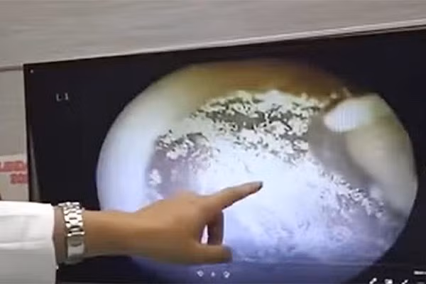 Nguoi phu nu suyt bi diec vi thoi quen nhieu nguoi Viet mac phai