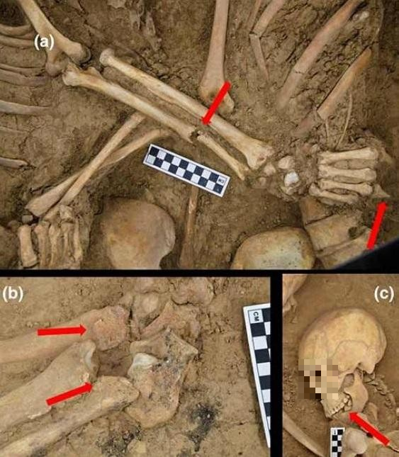 Phân tích xương cốt cho thấy người đàn ông có một vết gãy nặng và nhiễm trùng trên cánh tay phải, trong khi người phụ nữ khỏe mạnh hơn với chỉ một số vấn đề nhỏ về cột sống và răng.