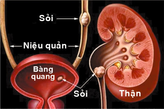 Những bệnh nhân bị sỏi thận có thể tham khảo ăn những loại hoa quả sau đây.