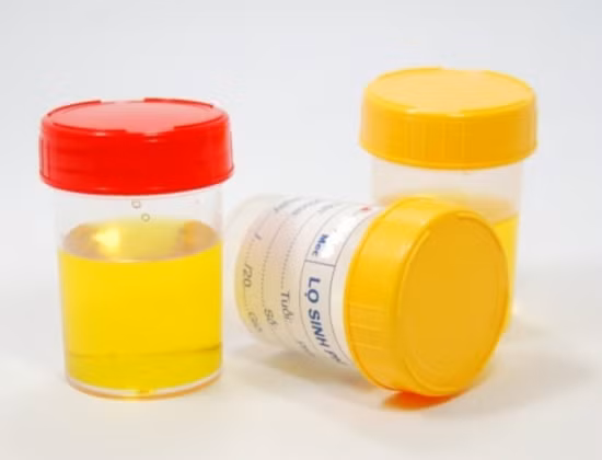 Khi bạn uống không đủ nước, cơ thể lại bài tiết mồ hôi nhiều sẽ khiến nồng độ nước tiểu đậm đặc, thành phần protein và các thành phần khác có trong nước tiểu sẽ cao khiến nước tiểu sinh bọt.