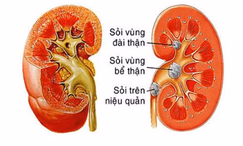 Việc ăn uống dành cho bệnh nhân bị sỏi thận cần phải được chú trọng. Người bị sỏi thận không phải hoa quả nào cũng ăn được nếu không sẽ khó ngăn ngừa sự hình thành của sỏi cũng như sự phục hồi của bệnh.