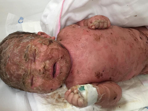 Bệnh nhi bị bong tróc da từng toàn thân với nguy cơ nhiễm trùng máu do biến chứng thủy đậu. Ảnh: LCM.