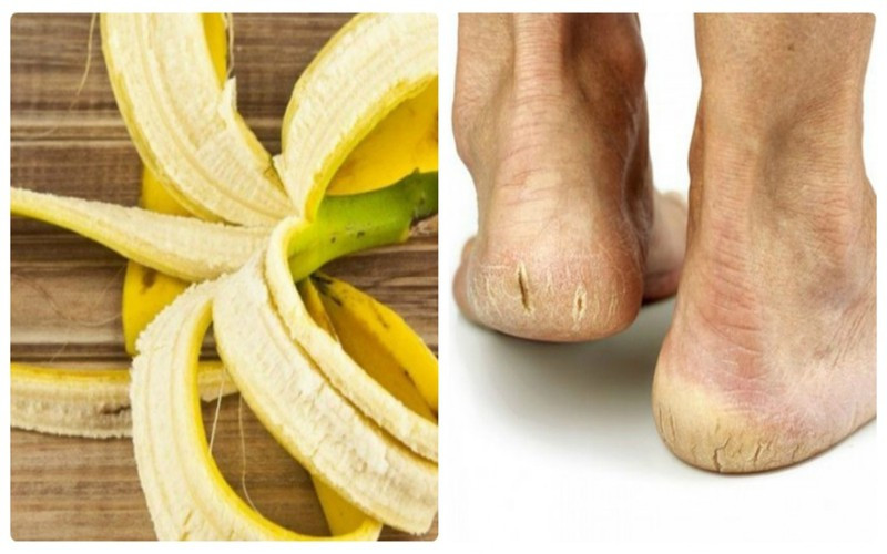 Trị nứt nẻ tay chân: Trong mùa lạnh, nguy cơ khô da, nứt nẻ da tay, chân, gót chân… là rất cao. Bạn có thể rửa sạch tay chân, sau đó chà sát mặt trong của vỏ chuối lên vùng da nứt nẻ. Kết quả thu về là da mềm mịn, hồng hào trở lại sau vài ngày liên tục sát vỏ chuối.