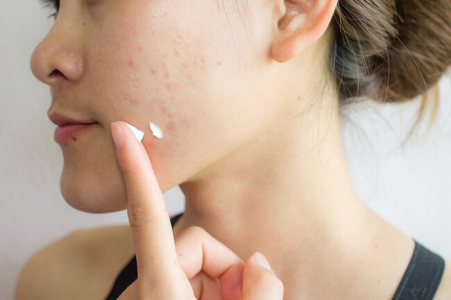 Dầu trị mụn tự nhiên: Bơ cacao, bơ hạt mỡ và dầu dừa có tác dụng dưỡng ẩm da tốt. Tuy vậy, các sản phẩm này có tính dầu, do đó không nên sử dụng trên mặt vì chúng có thể gây tắc lỗ chân lông và khiến tình trạng mụn tệ hơn.