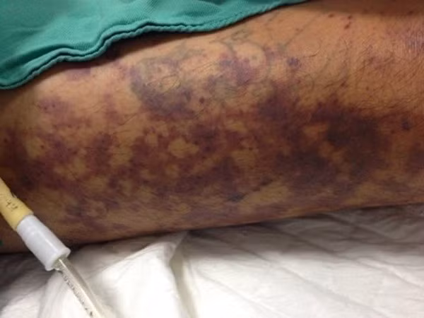 Viem mang nao do lien cau khuan lon: Chon thit lon the nao de tranh mac benh?