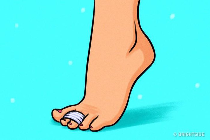 Băng các ngón chân của bạn: Bạn có thể dán từng ngón chân lại để giảm áp lực cho dây thần kinh giữa hai ngón chân gây đau.