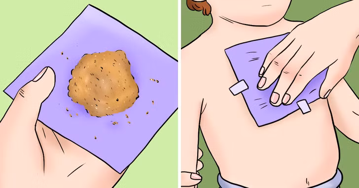 Miếng dán gừng: Phương pháp này khá dễ thực hiện bởi gừng luôn có sẵn trong căn bếp mỗi gia đình. Bạn cần kết hợp một chút bột mì, mật ong và dầu ô liu, với một muỗng canh gừng xay (hoặc bột gừng). Cho một ít hỗn hợp vào khăn ăn và đắp nó lên ngực trẻ rồi cố định bằng băng dính. Áp dụng khoảng 3 giờ trước khi đi ngủ.