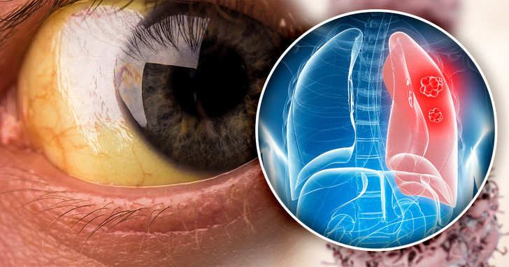 5 dau hieu bao dong phoi ban dang co van de-Hinh-4