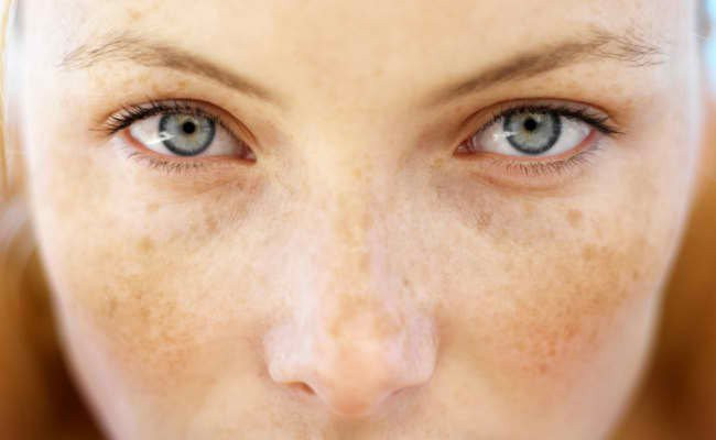 Nhờ các thành phần kháng viêm và khử trùng tuyệt vời, dầu kim ngân hoa còn có tác dụng làm giảm các nốt phát ban và mụn. Ngoài ra nó còn có tác dụng xoa dịu các vết bỏng nhẹ hay cháy nắng.