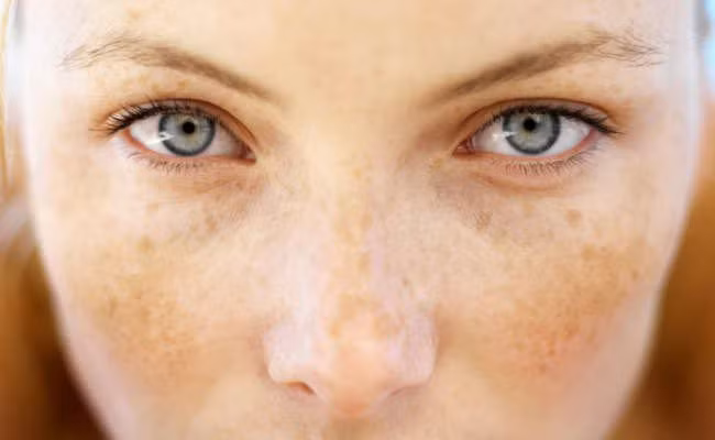 Nhờ các thành phần kháng viêm và khử trùng tuyệt vời, dầu kim ngân hoa còn có tác dụng làm giảm các nốt phát ban và mụn. Ngoài ra nó còn có tác dụng xoa dịu các vết bỏng nhẹ hay cháy nắng.