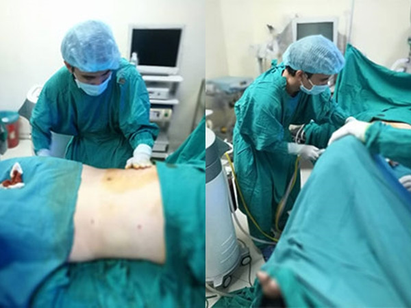 Trước đó, bệnh nhân nữ Đỗ N.A vào Bệnh viện An Việt phẫu thuật tạo hình thành bụng vào ngày 6/4 vừa qua. Sau khi gây tê tủy sống, bệnh nhân có biểu hiện bất thường. Ngay sau khi xảy ra tình trạng bệnh nhân nghi sốc phản vệ, Bệnh viện An Việt đã cấp cứu và chuyển bệnh nhân sang Bệnh viện Bạch Mai cấp cứu. Nguyên nhân tử vong được xác định do bệnh nhân hôn mê sâu, tổn thương thiếu máu não diện nặng, phù não nặng sau ngừng tuần hoàn.