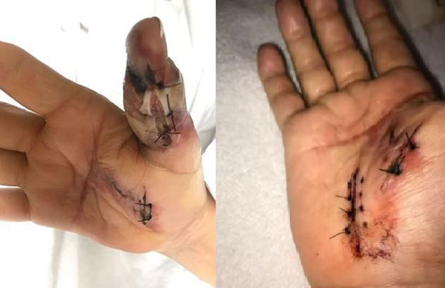 Suyt mat mang vi nhiem virus an thit khi di lam mong tay-Hinh-2